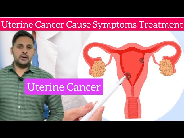 Uterine Cancer Cause Symptoms Diagnose Treatment in Hindi | What is Uterine Cancer | Uterine Cancer