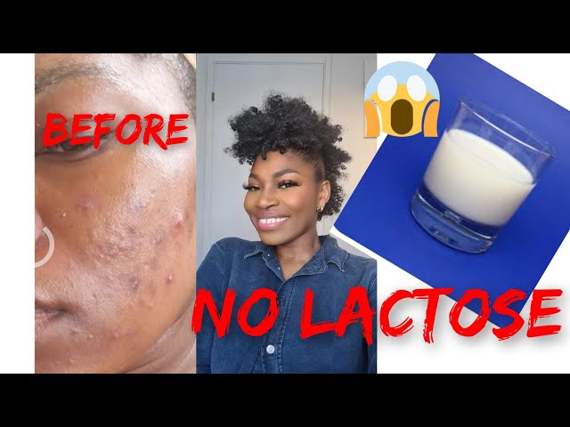 How to clear your acne/hyperpigmentation with NO LACTOSE 🚫| Get clear skin ditching diary products