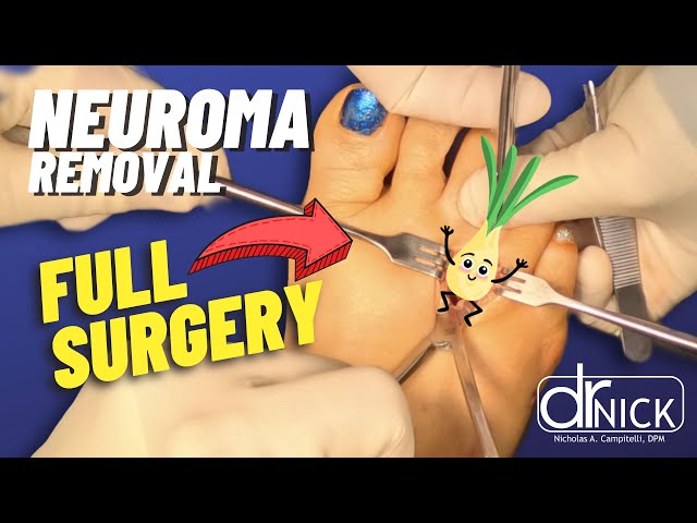 Understanding Neuromas: Causes, Treatments, and Surgical Removal with Dr. Nick Campitelli