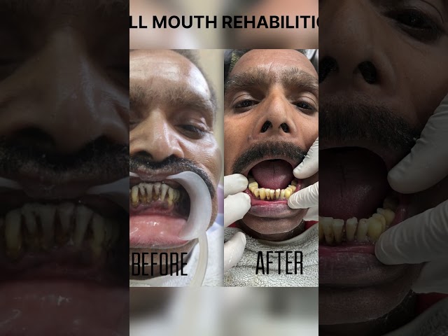 Full mouth cases #newsong #song#dentalesthetics #doctor #dentista #dentist #medical