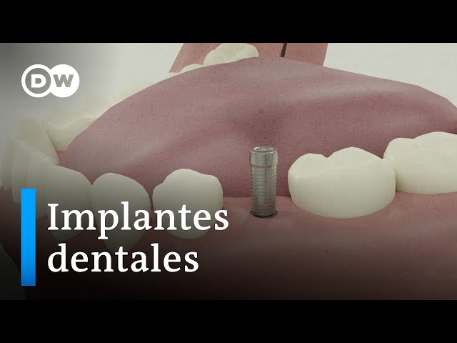 Implantes dentales: ventajas e inconvenientes