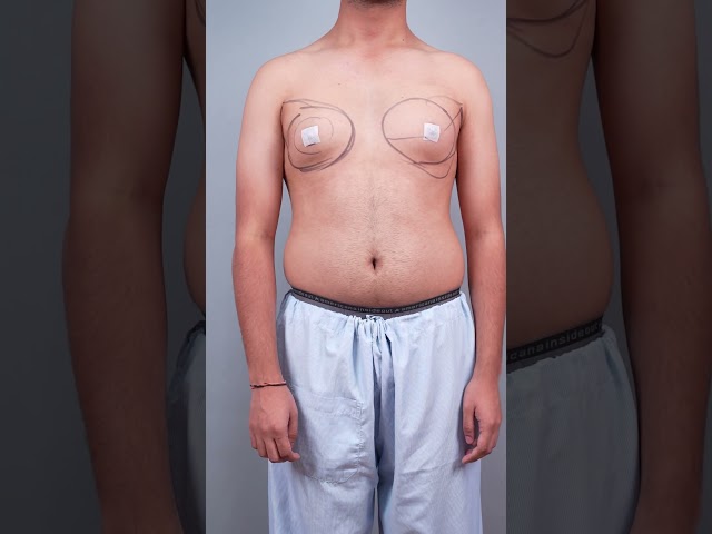 Gynecomastia cure | Manboobs surgery immediate result #shorts