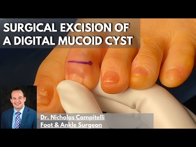 Excision of a digital mucoid cyst | Dr. Nick Campitelli