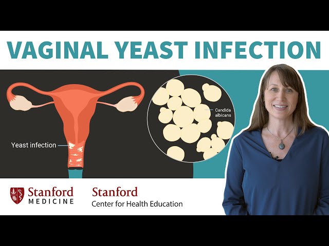 عفونت قارچی واژن: پزشک علل، علائم و درمان را توضیح می دهد | استانفورد