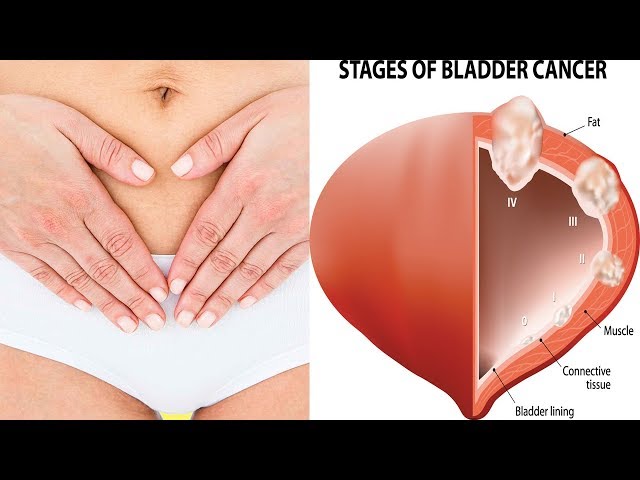 Symptoms of Bladder Cancer in Women | Top 5