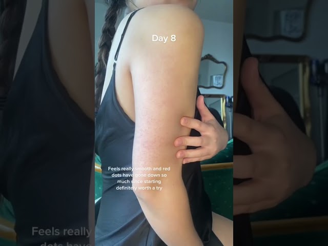 Kp update! // keratosis pilaris chicken skin strawberry skin body care skincare tips journey hacks