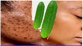 At 50 the wrinkles are gone! remove acne scars overnight !! best way to repair acne scars naturally!