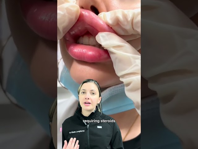 What are the risk of overfilled lip filler? Dr. Medispa