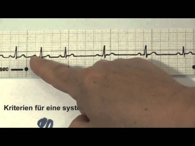 EKG für Pflege Teil 13 - atemabhängige Sinusarrhythmie interpretieren