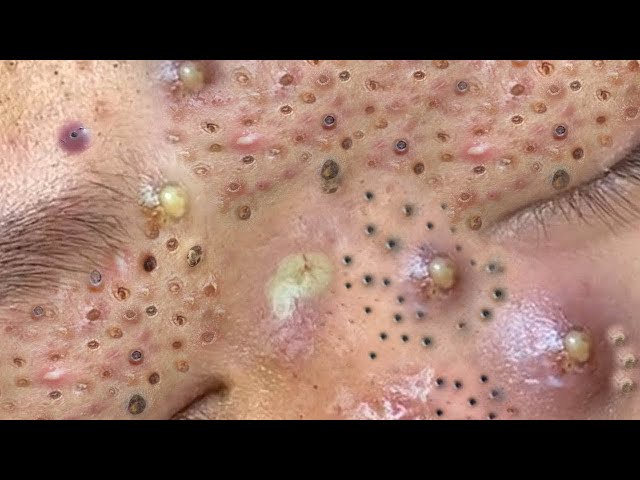 Acne Treatment | Best Daily Relax acne treatment Spa #0007723