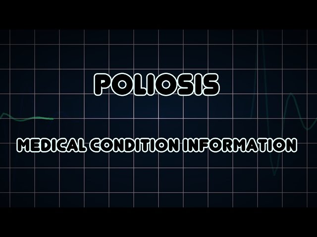 Poliosis (Medical Condition)