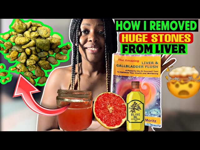 Naturally removing HUGE Gall stones using these 3 ingredients.(real life)🥵🤯