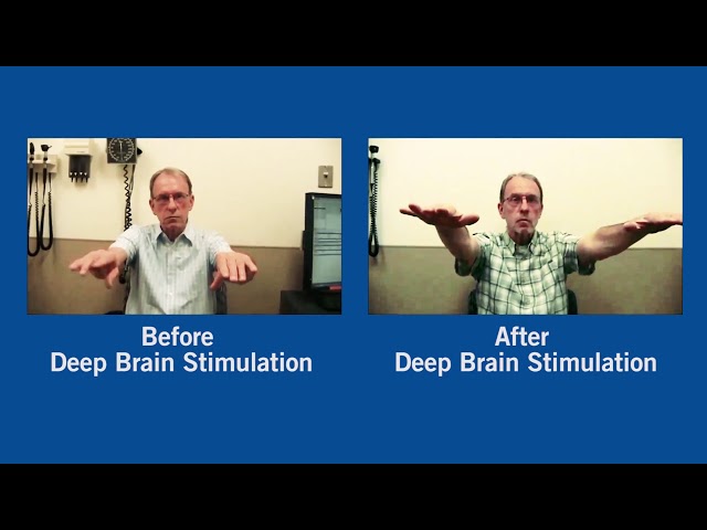 Parkinson's Disease Before and After Deep Brain Stimulation