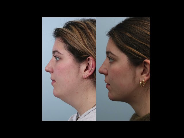 How to Choose Between a Deep Neck Lift vs Neck Liposuction: Non-Graphic Demonstration #youthful