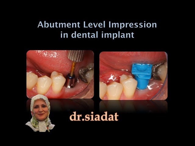 Abutment level impression in dental implant
