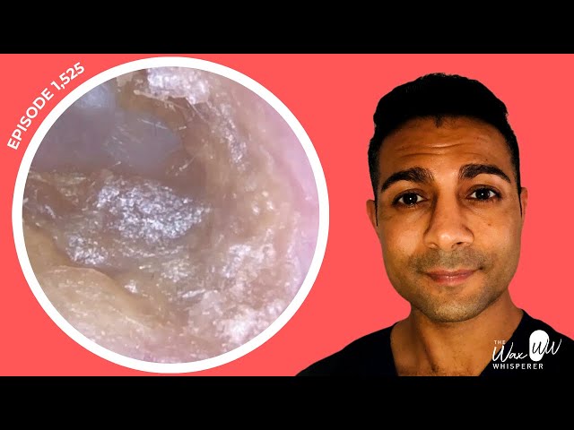 1,525 - Incredibly Itchy Dry Ear Wax & Dead Skin Extraction