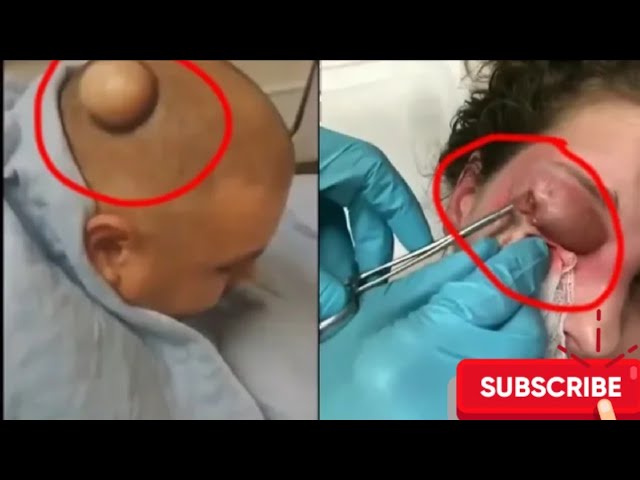 Satisfying Pimple, Black Head & Cyst popping Botfly Compilation || Remove  pimples on home