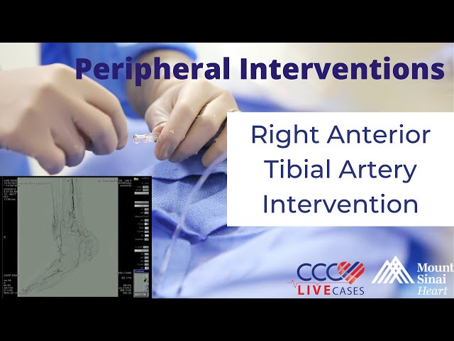 Right Anterior Tibial Artery Intervention - February 25, 2015 Live Case Video