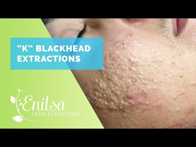 Blackheads, Whiteheads Extractions on "K" Part 1