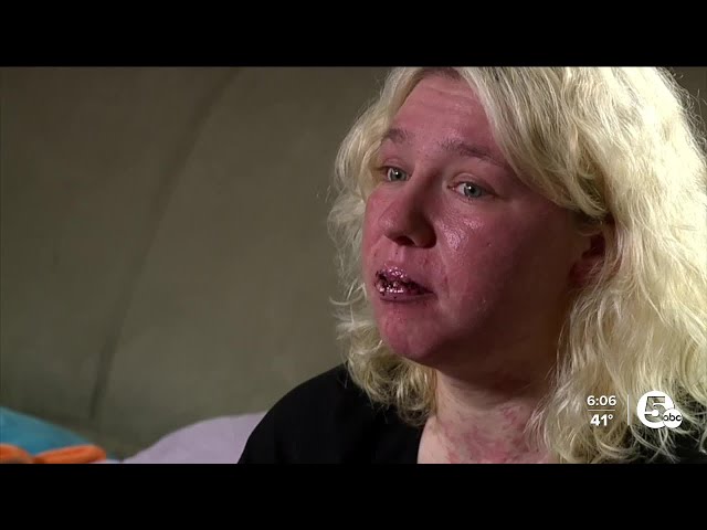 Akron woman experiences rare skin reaction after allergic reaction to medication