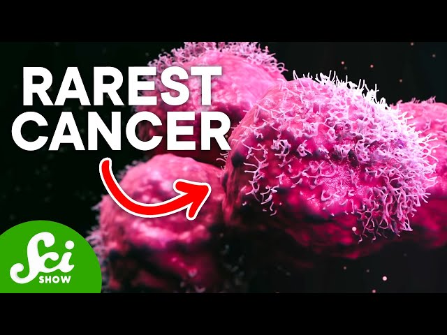 The Rarest Cancer on Earth: Only One Known Case