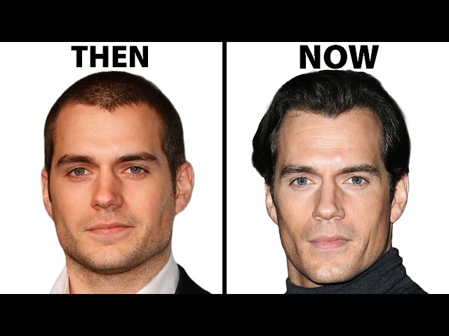 Is Henry Cavill's Face All Natural? | Plastic Surgery Analysis