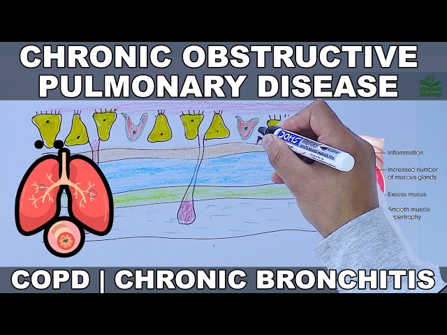 Chronic Obstructive Pulmonary Disease | COPD