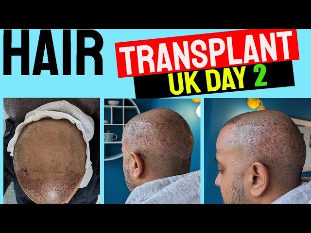 HAIR TRANSPLANT UK |  DAY 2 - PART 3 #hairtransformation #hairtransplant #fue #transplant