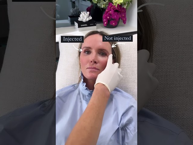 Non-Surgical Brow Lift | See The Results Immediately