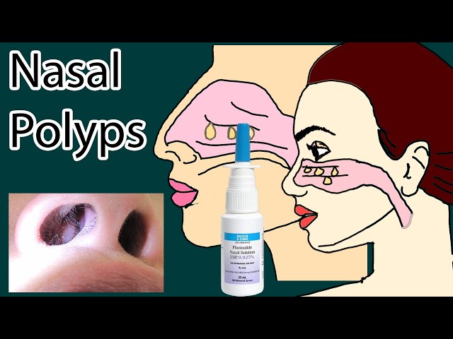 Nasal Polyps symptoms, causes  and treatment