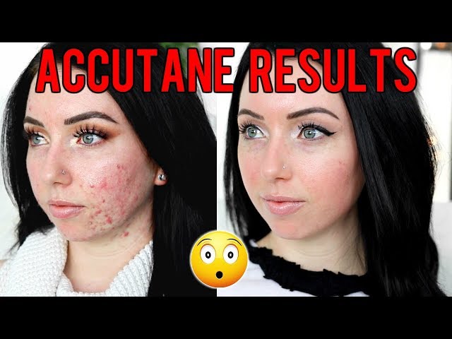 MY ACCUTANE JOURNEY 6 MONTH RESULTS Before & After, Side Effects, Would I Do it Again?...