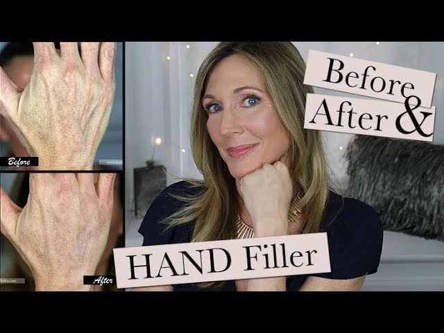 Hand Filler for Younger Looking Hands ~ My Experience Getting Radiesse