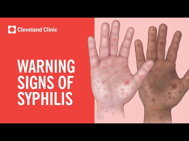 Warning Signs of Syphilis