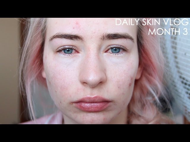 Roaccutane Daily Skin Vlog - Month 3