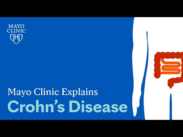 Mayo Clinic Explains Crohn’s Disease