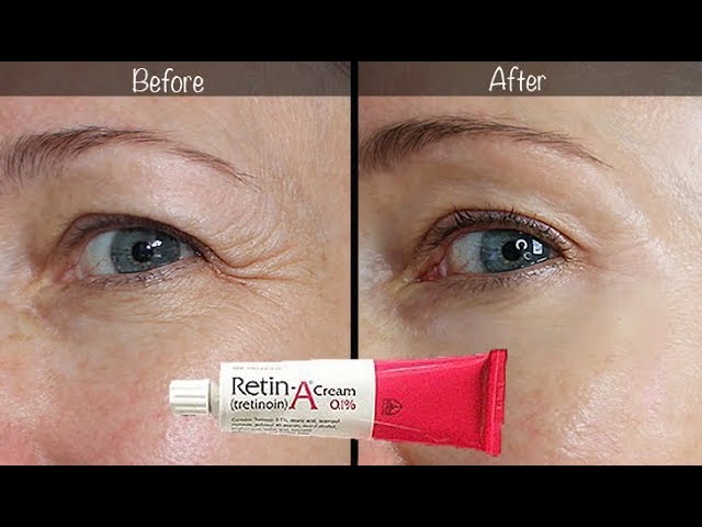 5-Year Retin-A Update ~ Before & After for Wrinkles & Anti-Aging!