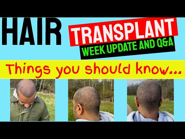 HAIR TRANSPLANT UK |  DAY 6 & Q&A #hairtransformation #hairtransplant #fue #transplant