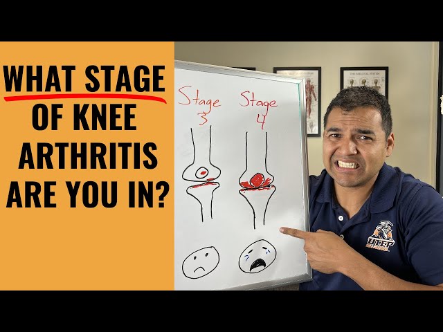 How To Clearly Tell Where You Are In The 4 Stages Of Knee Arthritis