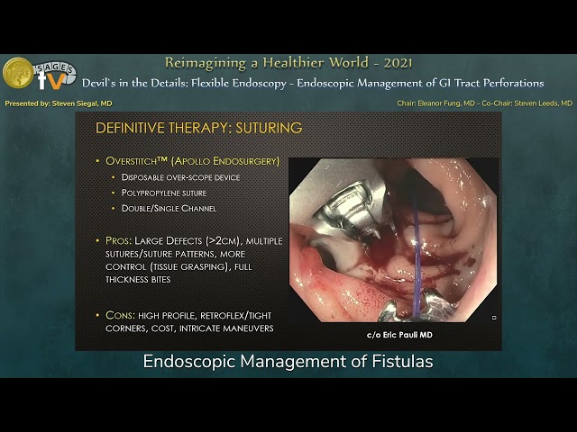 Endoscopic Management of Fistulas