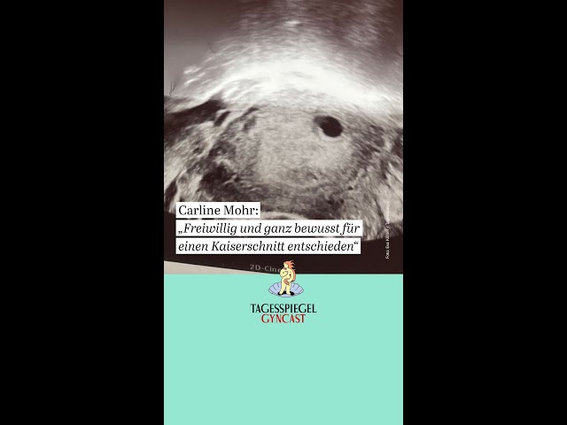 Live bei der Geburt: „Ganz bewusst für einen Kaiserschnitt entschieden“ | Gyncast
