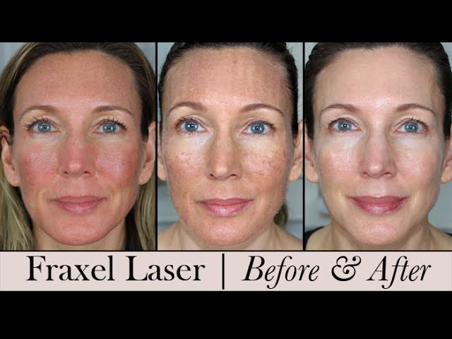 Fraxel Face Laser ~ Before & After! 3 Month Update