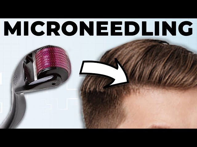 Microneedling For Hair Loss – New Insights! (Our Study)