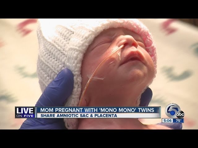 RARE: Mono Mono Twins Born Holding Hands