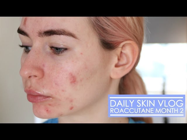 Roaccutane Daily Skin Vlog - Month 2