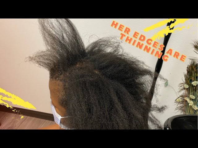 Her edges are thinning because of her job | she has Traction Alopecia