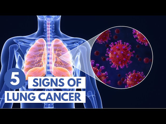 5 Signs of Lung Cancer | 3D Animation