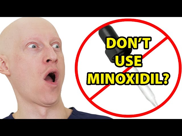 Why I Hate Topical Minoxidil (Rogaine)