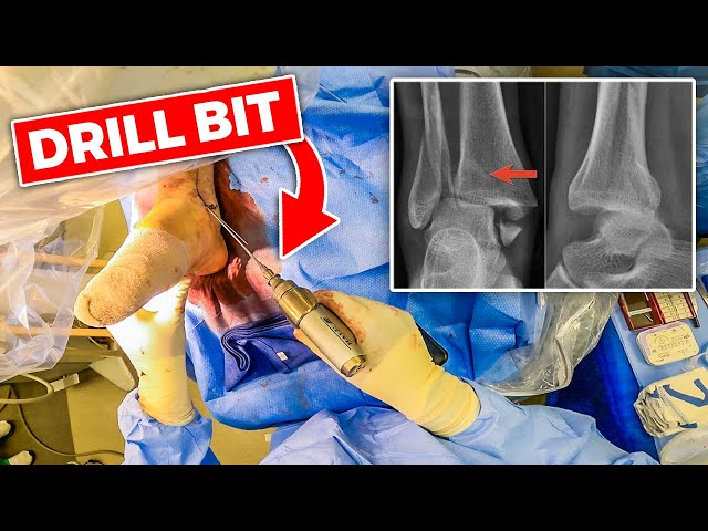 INSIDE THE OR: Ankle Fracture Open Reduction Internal Fixation (Surgical Video)