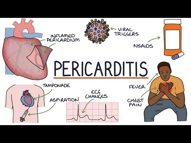 Understanding Pericarditis