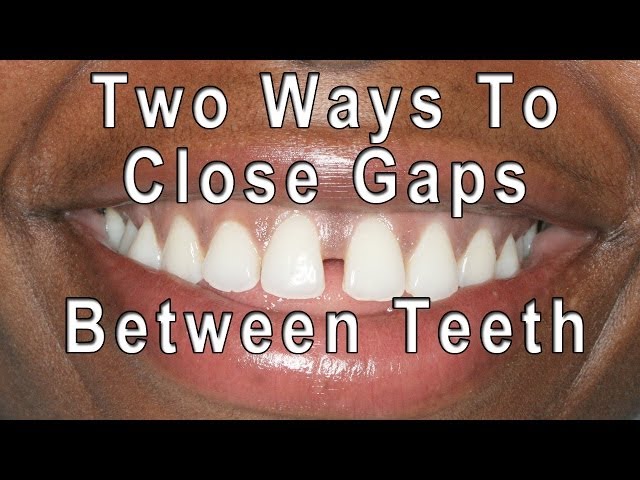 How to Close Gaps Between Teeth